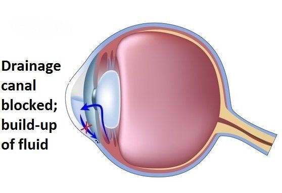 Eye diagram showing drainage canal blocked and build up of fluid