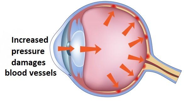 Eye diagram showing how increased pressure can damage blood vessels