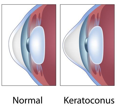 Keratoconus-final-480w