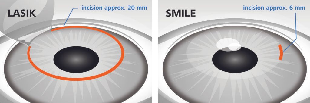 Lasik-SMILE-SideBySideIllustrations-1024x342-1228w