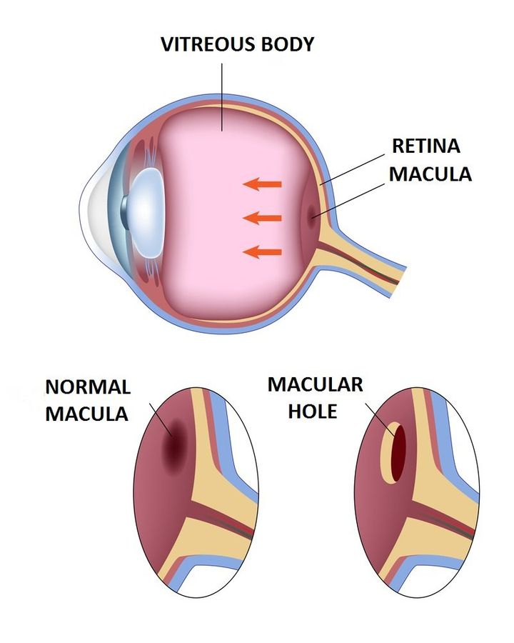 Macular-Hole1-720w