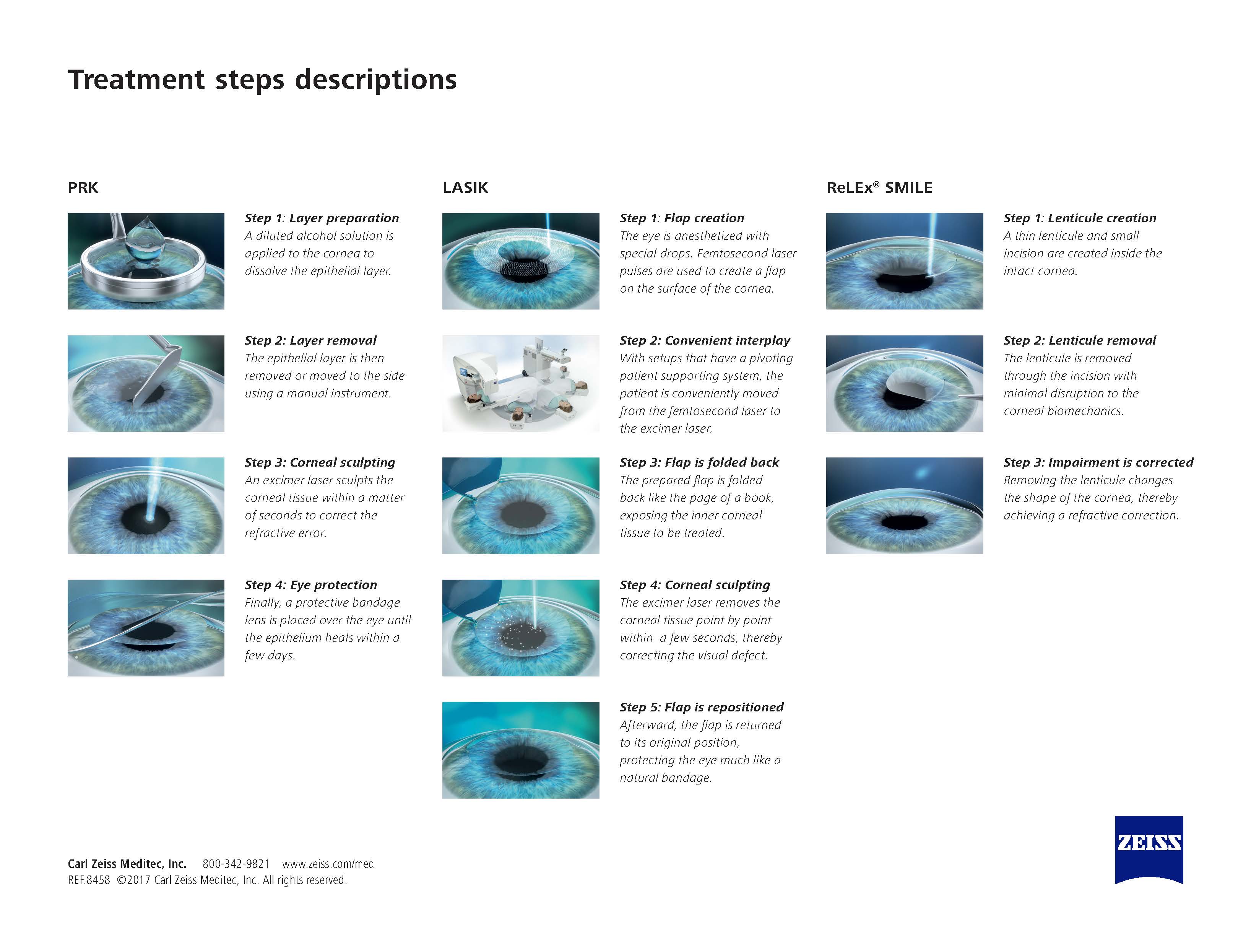 PRK-LASIK-SMILE---Treatment-Steps-2