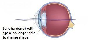 Presbyopia--1920w