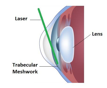 Diagram showing Select Laser Trabeculoplasty Procedure